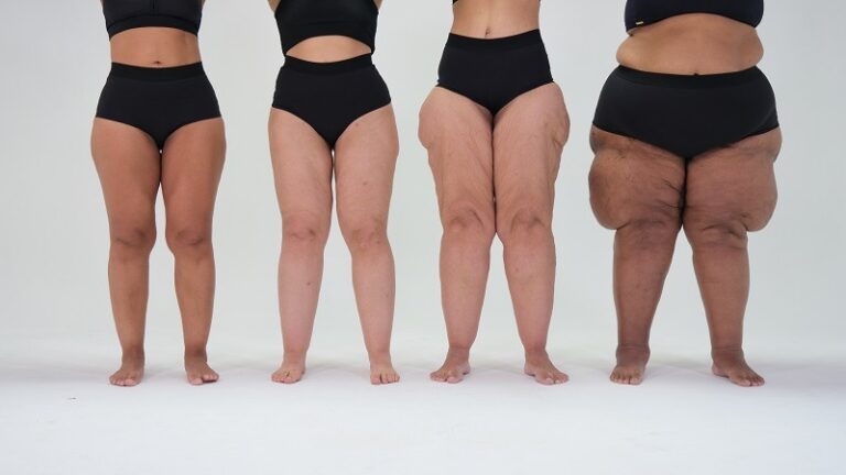 Estudo revela por que pacientes com lipedema têm dificuldade em ganhar massa muscular