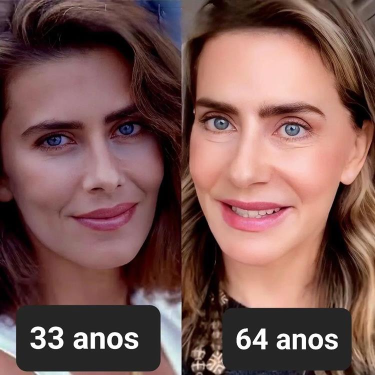 O Que é o Botox Preventivo e Como Ele Funciona? - inspiração 1
