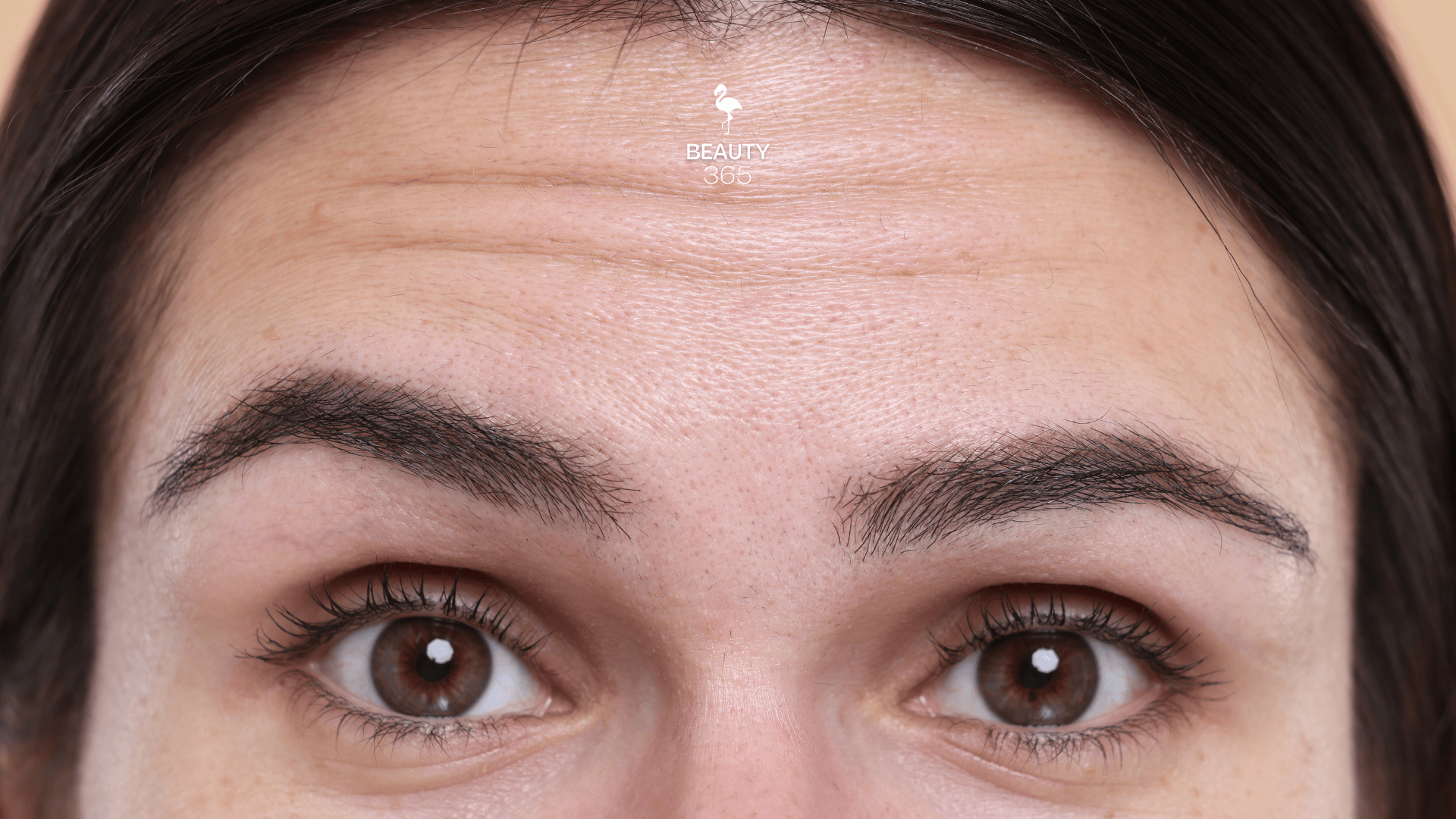 Quem Pode se Beneficiar do Botox Preventivo? - inspiração 1