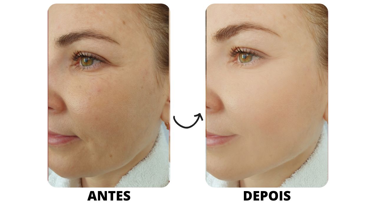 Quem Pode se Beneficiar do Botox Preventivo? - inspiração 2