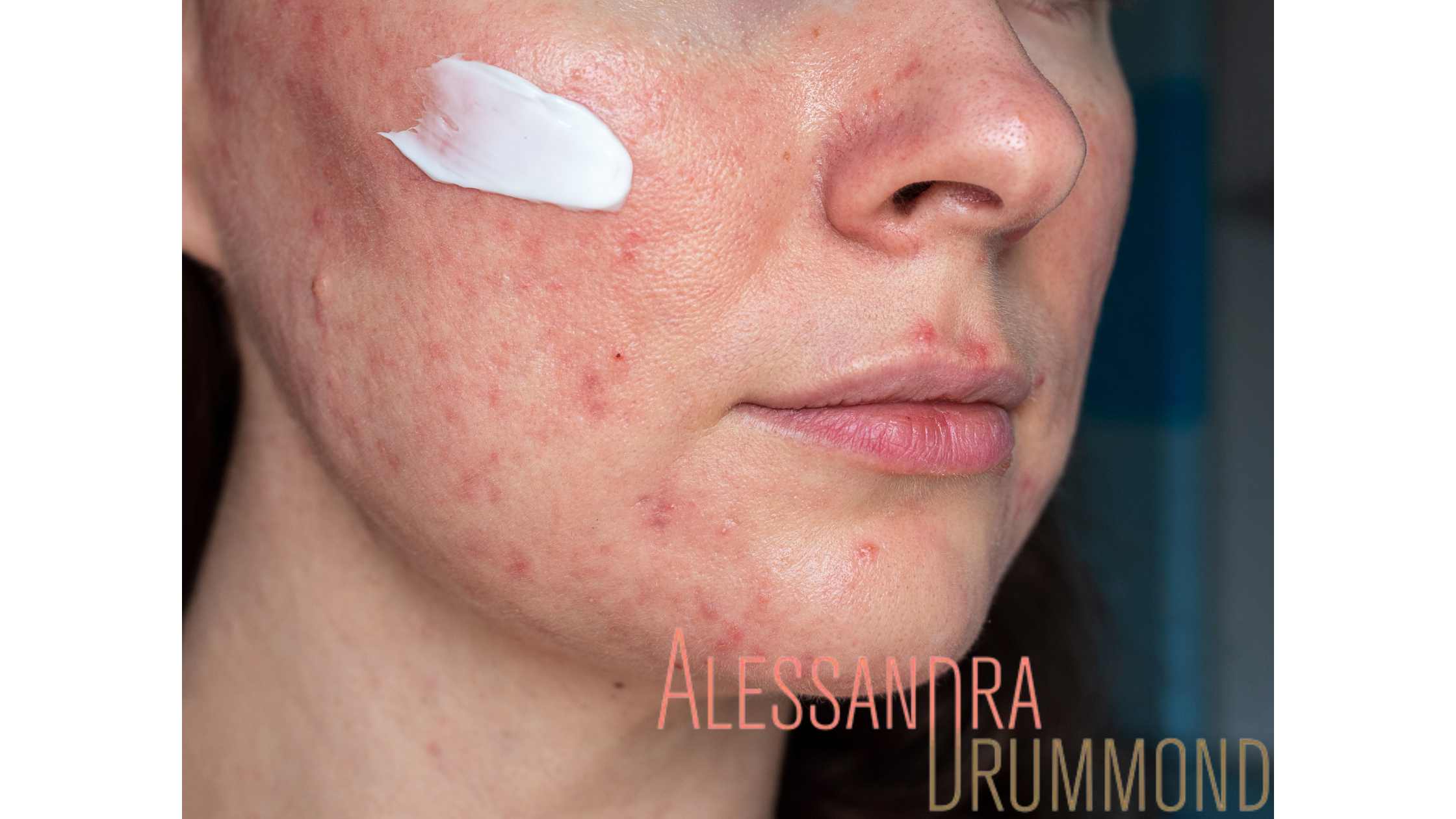 Guia Completo: Identificando e Evitando Gatilhos da Rosácea