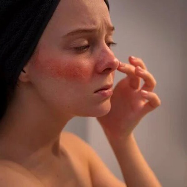 Protetor Solar para Rosácea: Escolha o Ideal para Não Irritar