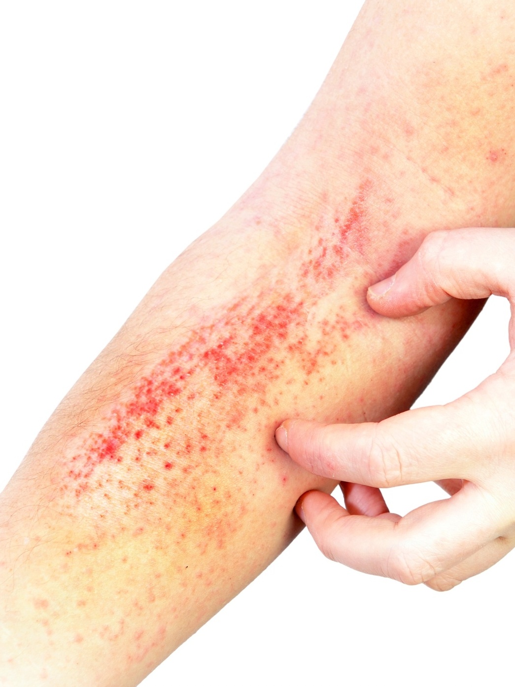 Guia Completo: Identificando e Evitando Gatilhos da Rosácea