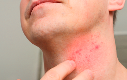 Os Melhores Ingredientes Calmantes para Pele Sensível e Vermelha