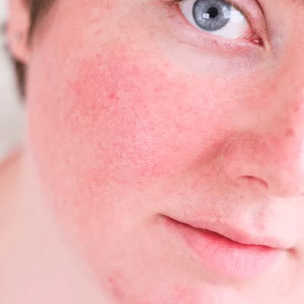 Protetor Solar para Rosácea: Escolha o Ideal para Não Irritar