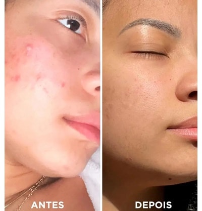 Diferença entre Pele Sensível e Rosácea: Quando Procurar um Médico