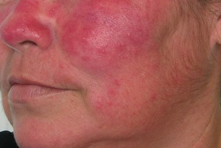 Guia Completo: Identificando e Evitando Gatilhos da Rosácea