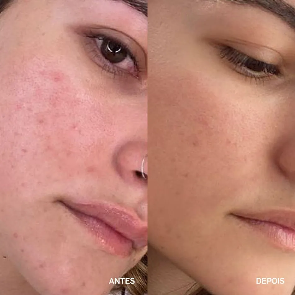 ácido glicólico para que serve