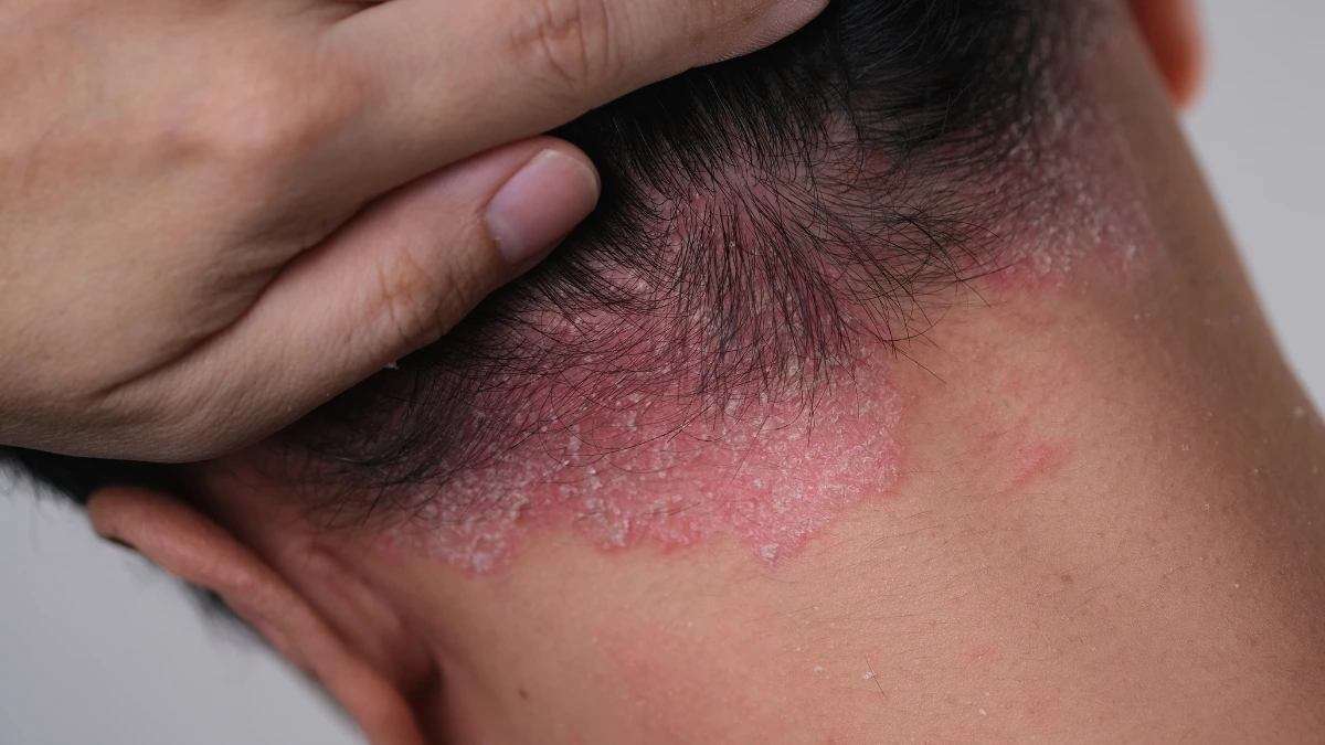 Guia completo dos tratamentos tópicos para psoríase