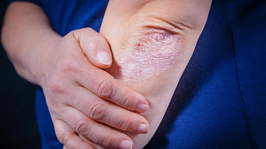 Psoríase no verão: cuidados essenciais com a exposição solar