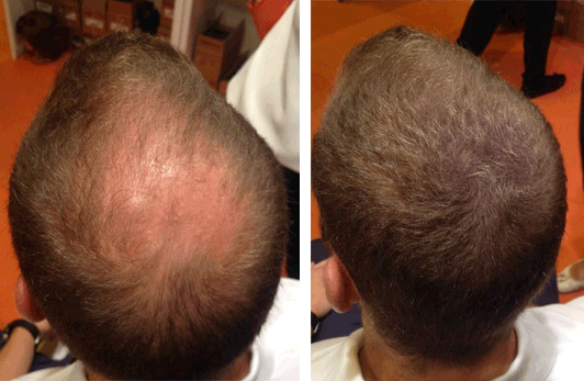 Barba e Calvície: Como Usar a Barba para Equilibrar seu Visual