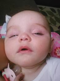 Blefaroplastia e Botox: Soluções Estéticas para Pálpebras Caídas