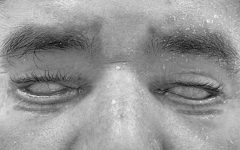 Exercícios Faciais para Rejuvenescer o Olhar: Fortalecimento da Pálpebra