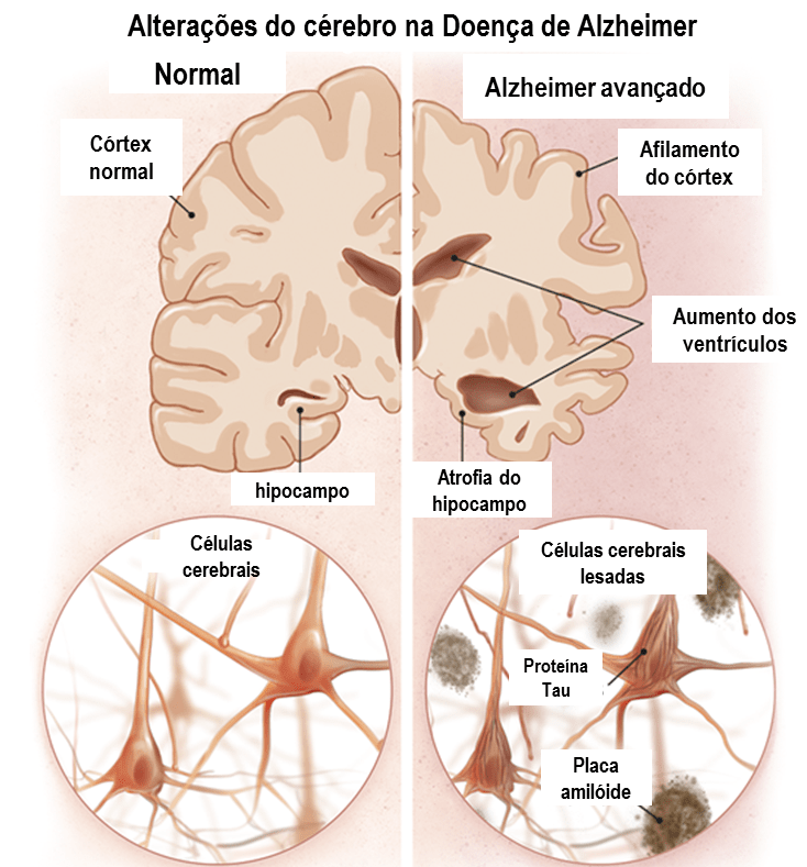 causas da doença de alzheimer