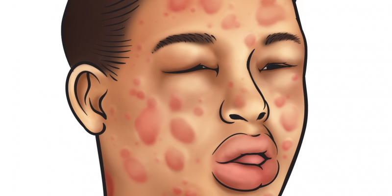 custo do tratamento de anafilaxia