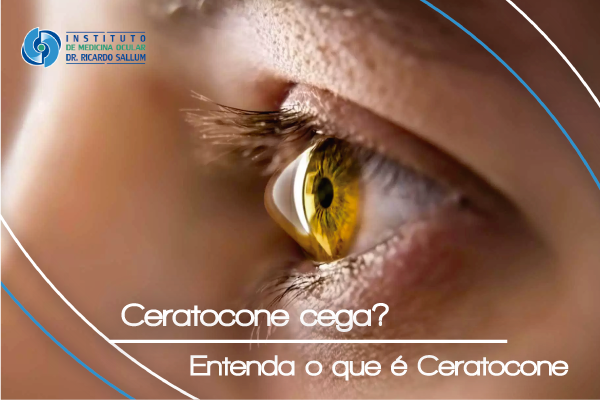 erros comuns ao diagnosticar ceratocone