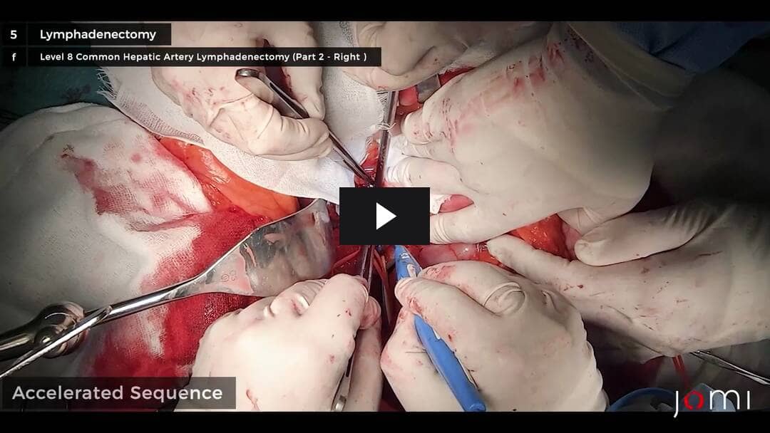 erros comuns após cirurgia de vesícula