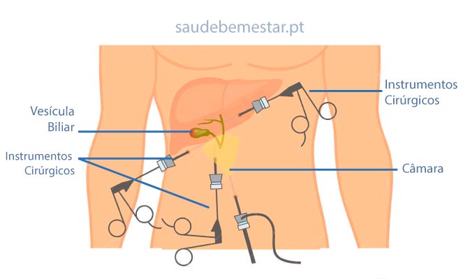colecistectomia laparoscópica vs aberta
