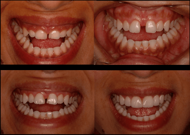 erros comuns ao tratar diastema