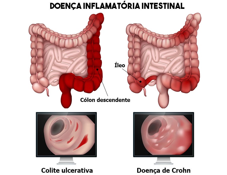 doença de crohn o que é