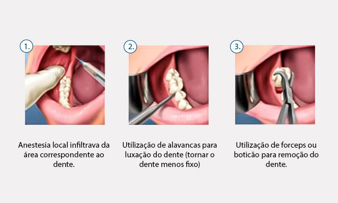 tipos de exodontia e quando fazer