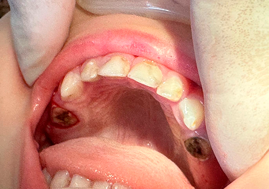 exodontia de siso incluso procedimento