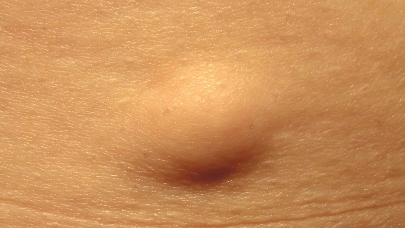 lipoma o que é