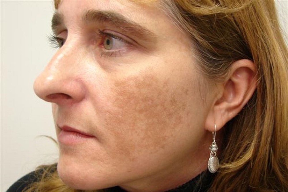 melasma o que é e como tratar