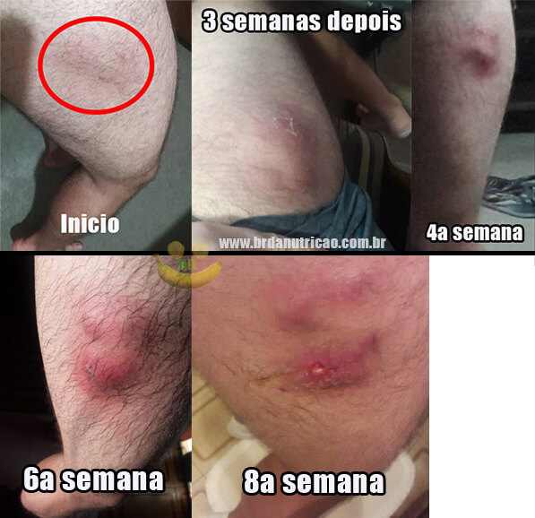 tipos de abscesso e quando se preocupar