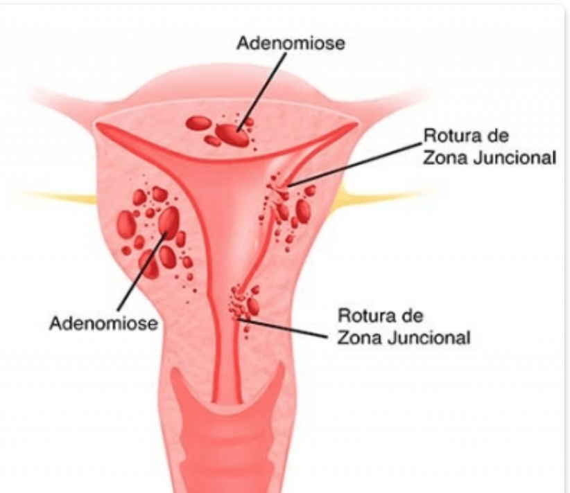 o que causa adenomiose no utero