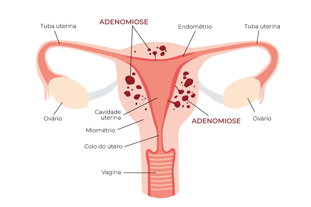 adenomiose é perigoso ou normal