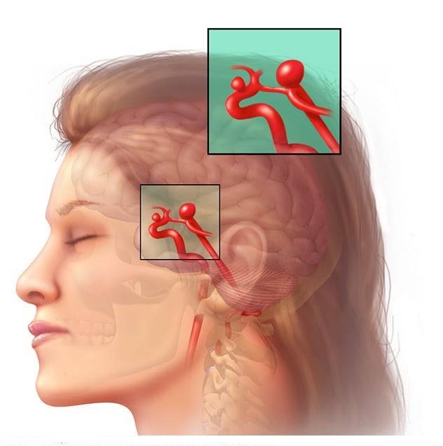 tipos de aneurisma cerebral e seus riscos