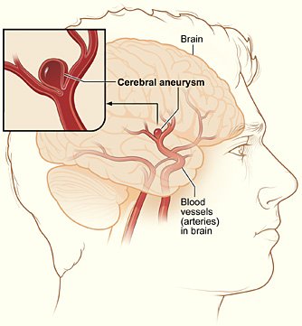 aneurisma cerebral vs malformação arteriovenosa