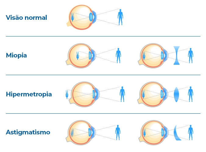 sintomas de astigmatismo