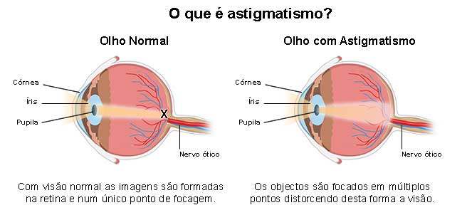 diferença entre miopia e astigmatismo