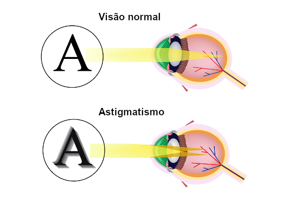melhores óculos para astigmatismo