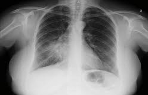 o que é atelectasia