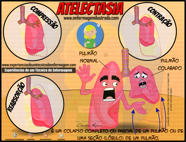 tipos de atelectasia e seus sintomas