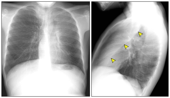 erros comuns no tratamento de atelectasia