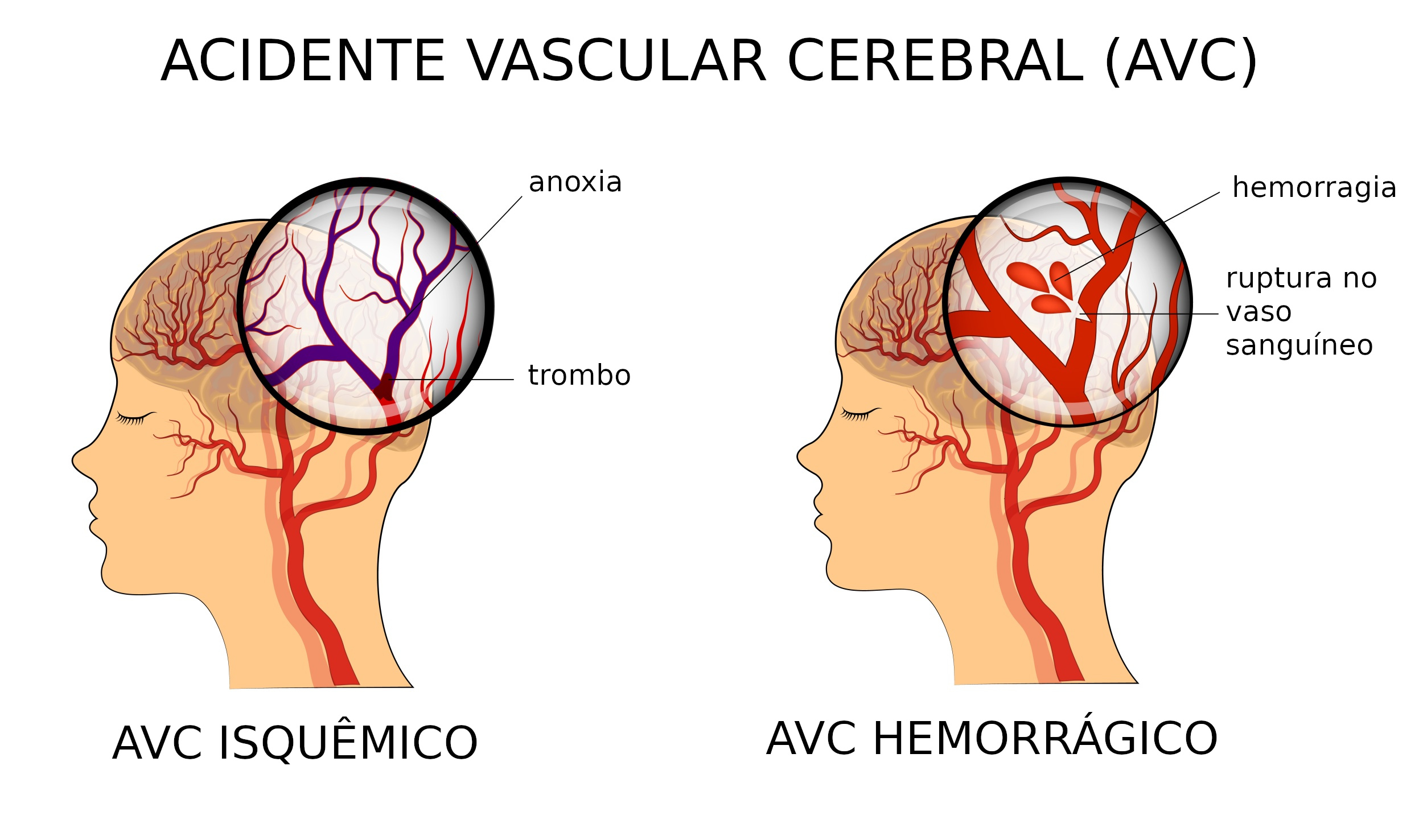 o que é derrame cerebral