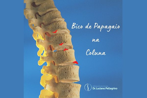 o que é bico de papagaio na coluna