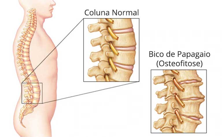 bico de papagaio na coluna vs hérnia de disco
