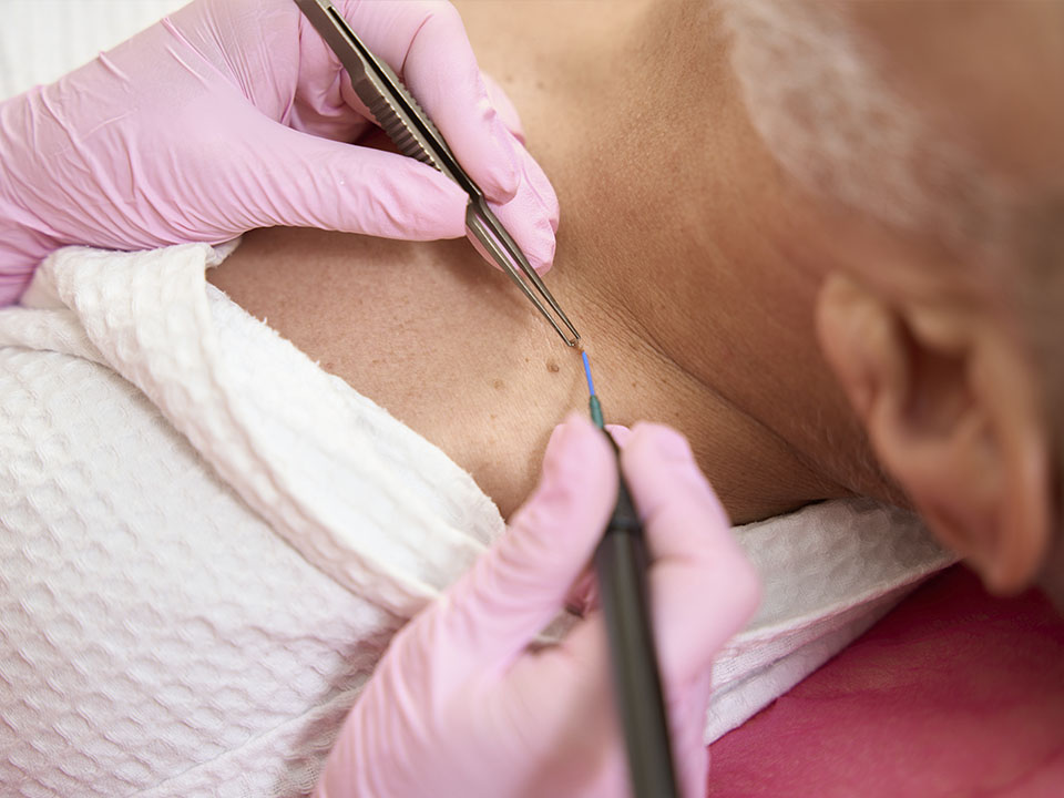 melhores tipos de biopsia para cada doença