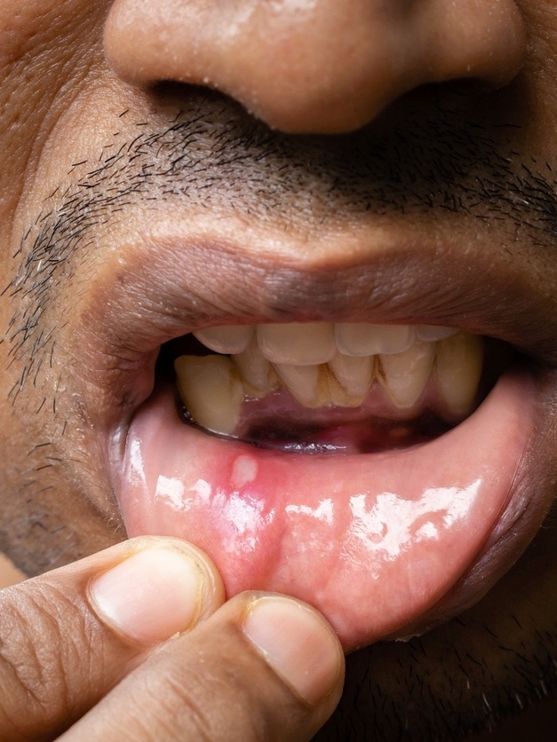 melhores remédios caseiros para afta