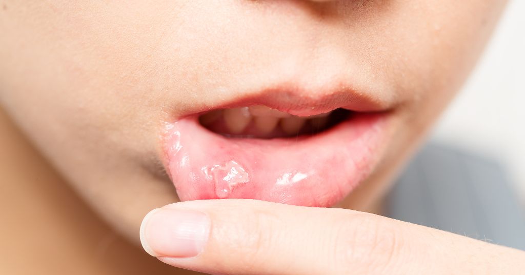 erros comuns ao tratar afta na boca