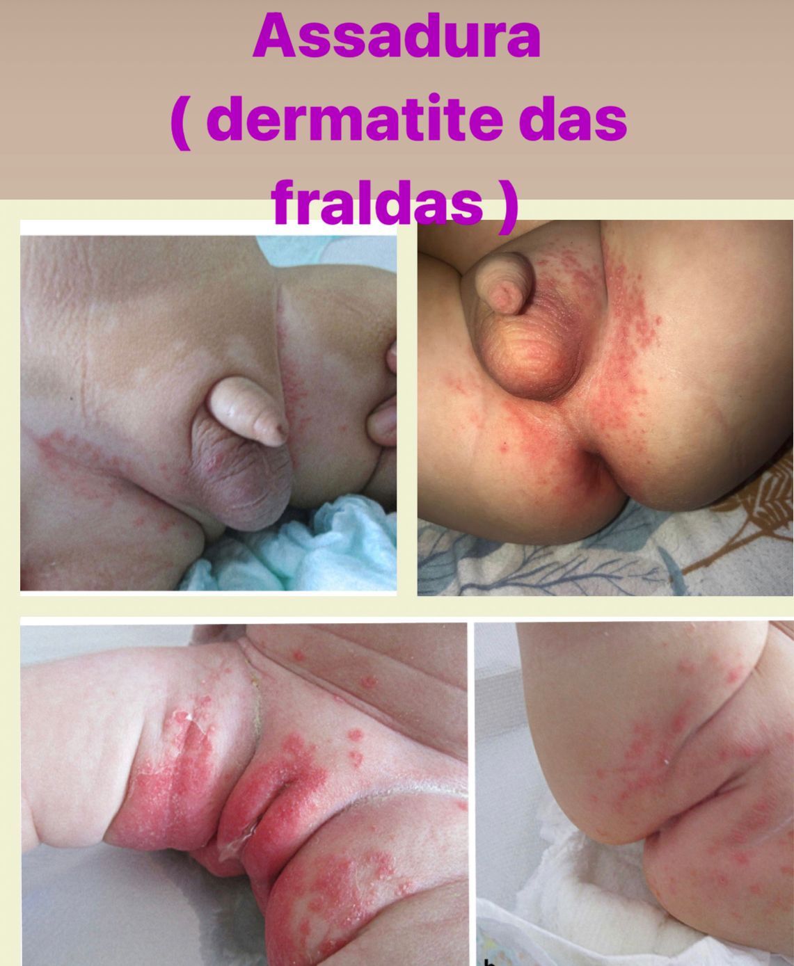 tratamento assadura bebê