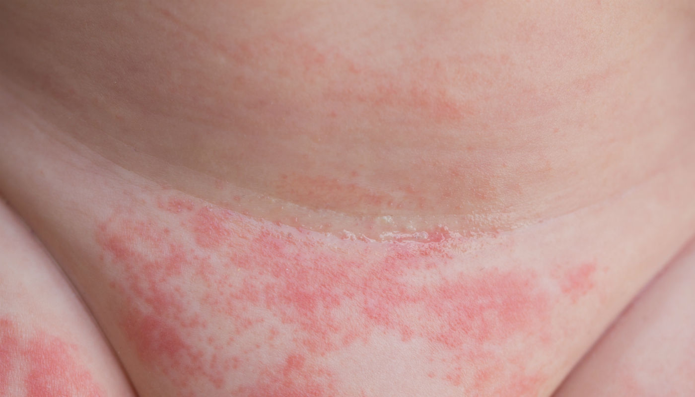 creme para assadura infantil