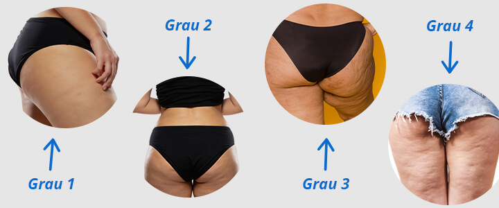 erros comuns ao tratar celulite infecciosa