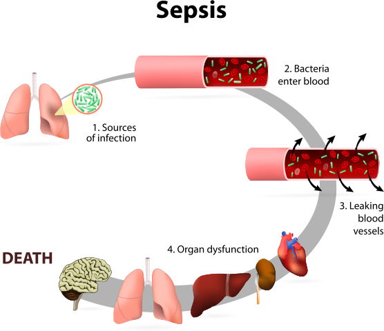 o que é choque séptico