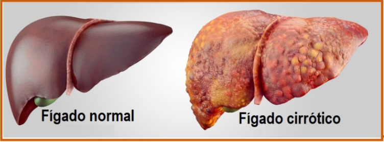 o que é cirrose hepática